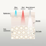 Near infrared light 660 NM and Methylene Blue for prostate cancer